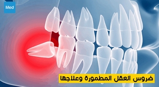 Magazine ضروس العقل المطمورة وعلاجها