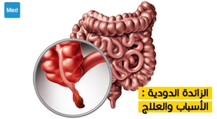 Magazine الزائدة الدودية : الأسباب والعلاج