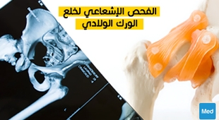 Makaleler الفحص الإشعاعي لخلع الورك الولادي