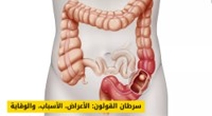 المجلة الطبية سرطان القولون: الأعراض، الأسباب، وكيفية الوقاية والتشخيص المبكر
