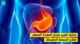 Magazine عملية تغيير مسار المعدة المصغر لعلاج السمنة المفرطة