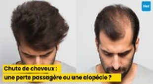 Magazine Chute de cheveux : comment distinguer une perte passagère d’une alopécie ?