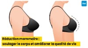 Magazine Réduction mammaire : soulager le corps et améliorer la qualité de vie
