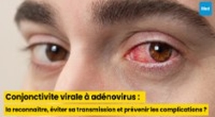 Magazine Conjonctivite virale à adénovirus : comment la reconnaître, éviter sa transmission et prévenir les complications ?