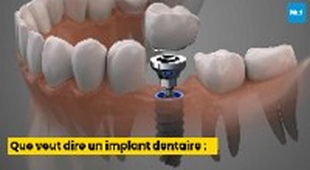 Magazine Que veut dire un implant dentaire