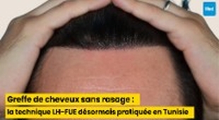 Magazine Greffe de cheveux sans rasage : la technique LH-FUE désormais pratiquée en Tunisie