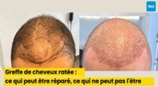 المجلة الطبية Greffe de cheveux ratée : ce qui peut être réparé, ce qui ne peut pas l'être