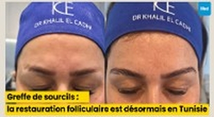 المجلة الطبية Greffe de sourcils : une microchirurgie de restauration folliculaire, désormais pratiquée en Tunisie