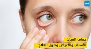 Makaleler جفاف العين: الأسباب والأعراض وطرق العلاج