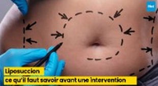 Magazine Liposuccion : ce qu’il faut savoir avant une intervention