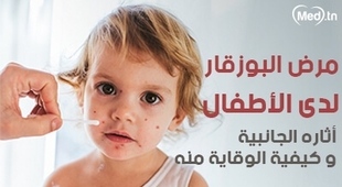 Magazine مرض البوزقار لدى الأطفال أثاره الجانبية و كيفية الوقاية منه