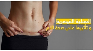 Magazine العملية القيصرية و تأثيرها على صحة الأم