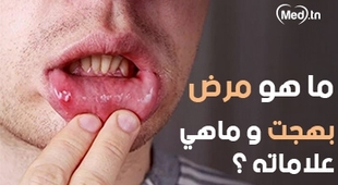 Magazine ماهو مرض بهجت و ماهي علاماته ؟