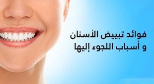 Makaleler فوائد تبييض الأسنان و أسباب اللجوء إليها 