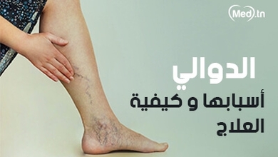 الدوالي أسبابها و كيفية العلاج