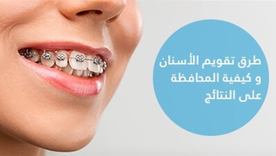 طرق تقويم الأسنان و كيفية المحافظة على النتائج