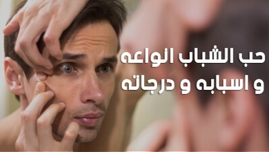 حب الشباب انواعه و اسبابه و درجاته