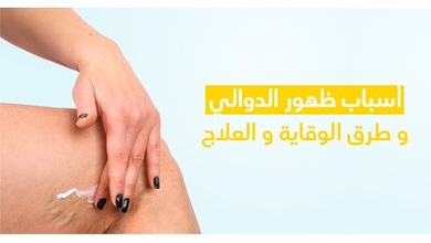 أسباب ظهور الدّوالي و طرق الوقاية و العلاج 
