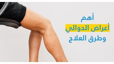 أهمّ أعراض الدّوالي وطرق العلاج
