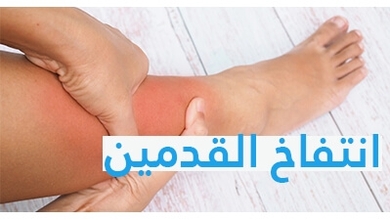 انتفاخ القدمين