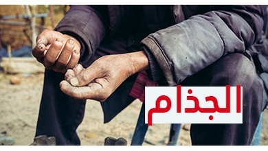 الجذام