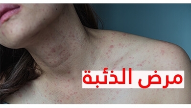 الذئبة الحمراء