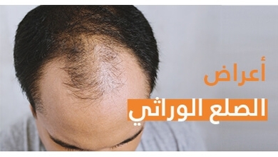 علاج الصلع الوراثي