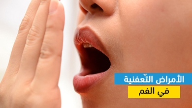 الأمراض التّعفنية في الفم