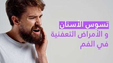 تسوّس الأسنان و الأمراض التّعفنية في الفم