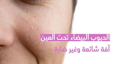 الحبوب البيضاء تحت العين آفة شائعة وغير ضارّة