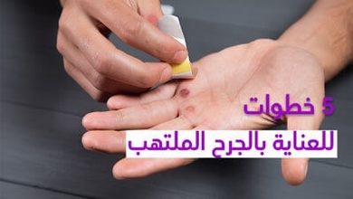 5 خطوات للعناية بالجرح الملتهب