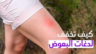 كيف تخفف لدغات البعوض