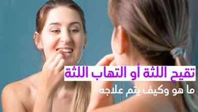 تقيح اللثة أو التهاب اللثة ما هو وكيف يتم علاجه