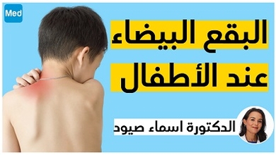 البقع البيضاء عند الأطفال