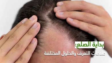 بداية الصلع: علامات التعرف والحلول المختلفة