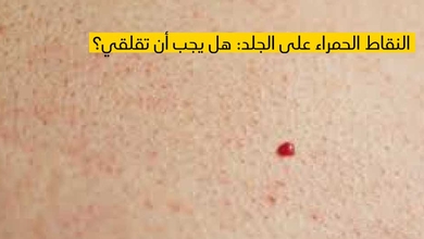 النقاط الحمراء على الجلد: هل يجب أن تقلقي؟