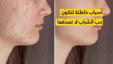 أسباب خاطئة لتكوّن حبّ الشّباب لا تصدّقها