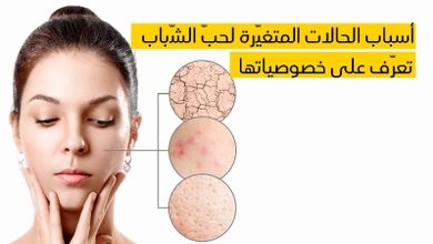 أسباب الحالات المتغيّرة لحبّ الشّباب وكيفيّة علاجها