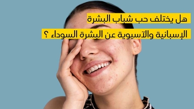  هل يختلف حب شباب البشرة الإسبانية والآسيوية عن البشرة السوداء ؟