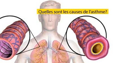 Quelles sont les causes de l