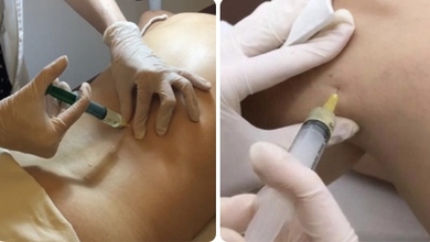 La mésothérapie, une technique de pointe pour soulager la douleur