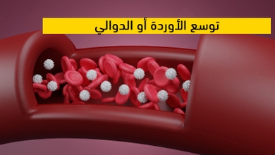  توسع الأوردة أو الدوالي  