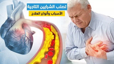 تصلب الشرايين التاجية : الأسباب وأنواع العلاج