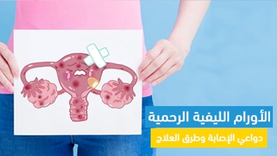 الأورام الليفية الرحمية: دواعي الإصابة وطرق العلاج