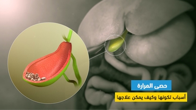 حصى المرارة : أسباب تكونها وكيف يمكن علاجها