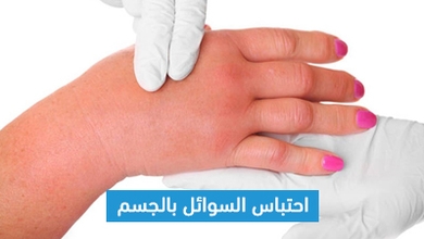 احتباس السوائل بالجسم