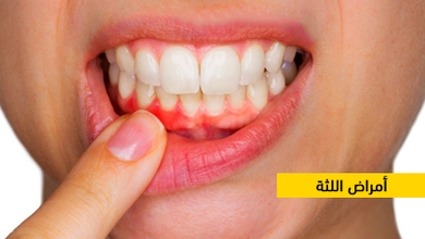 أمراض اللثة