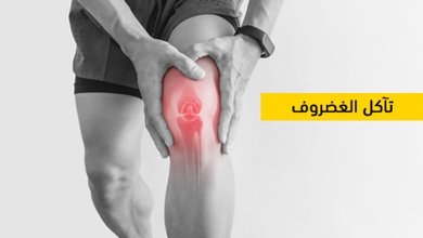 تآكل الغضروف