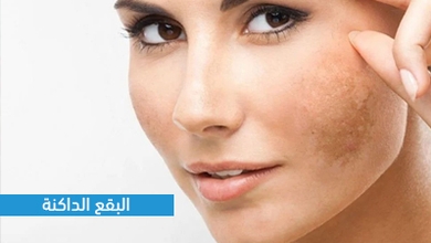 البقع الداكنة