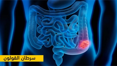 سرطان القولون